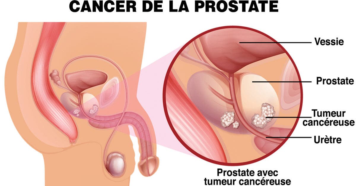 12 symptômes du cancer de la prostate auxquels il faut faire attention