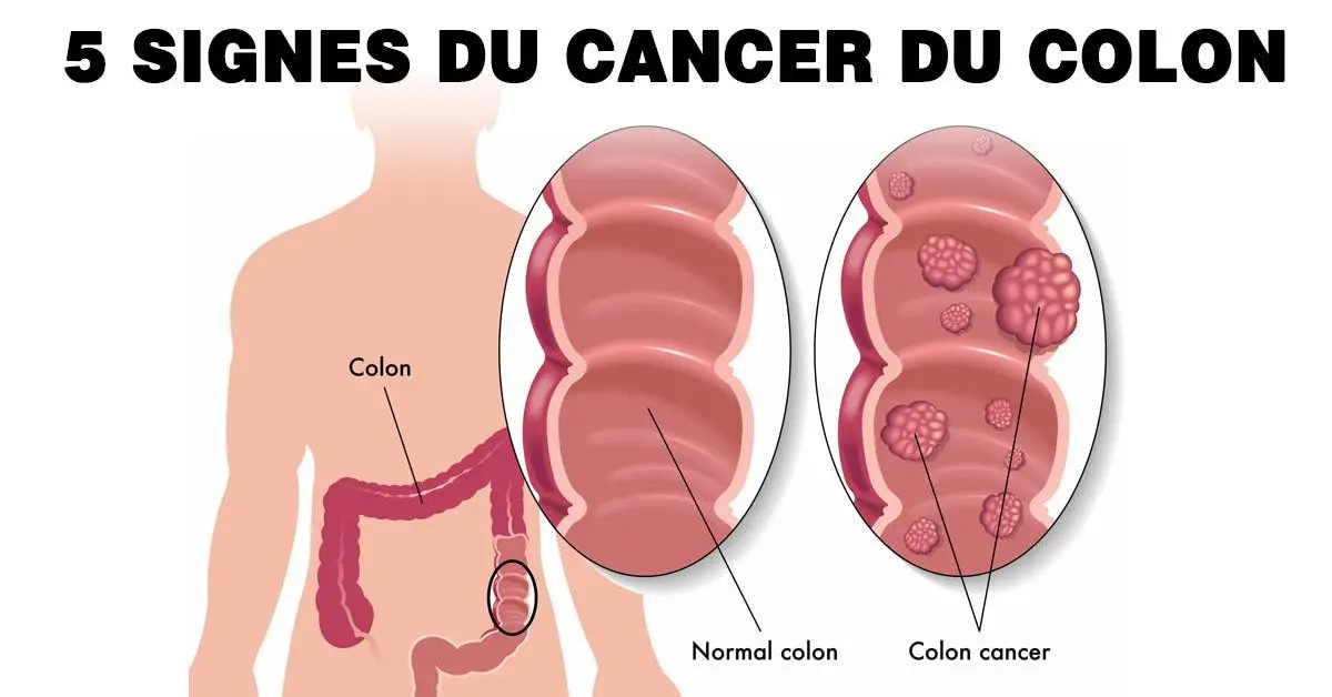 Le cancer du colon est un tueur silencieux : 5 signes inhabituels à repérer