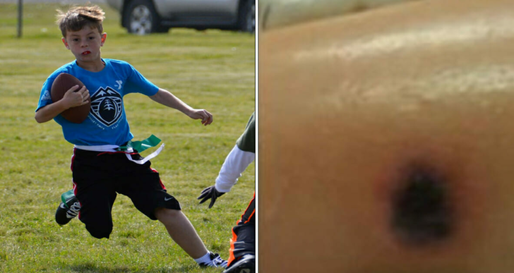 Un enfant de 10 ans a une étrange marque sur la jambe après un match de football – décède à l’hôpital 9 jours plus tard